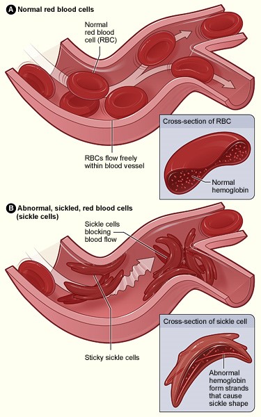 anemia.jpg