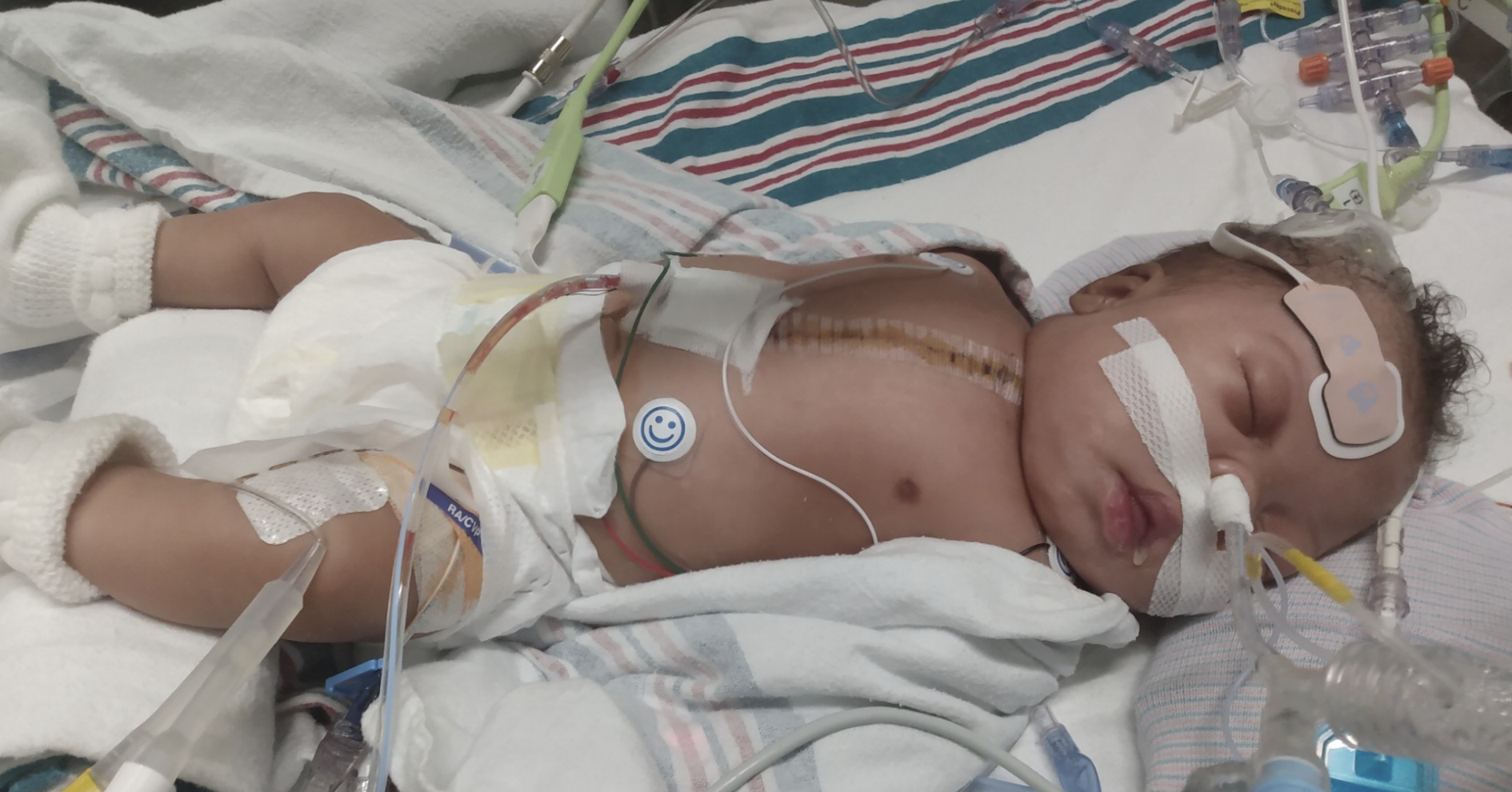 Defying the Odds: 1.3 Pound Newborn Undergoes Complex Open-Heart Surgery