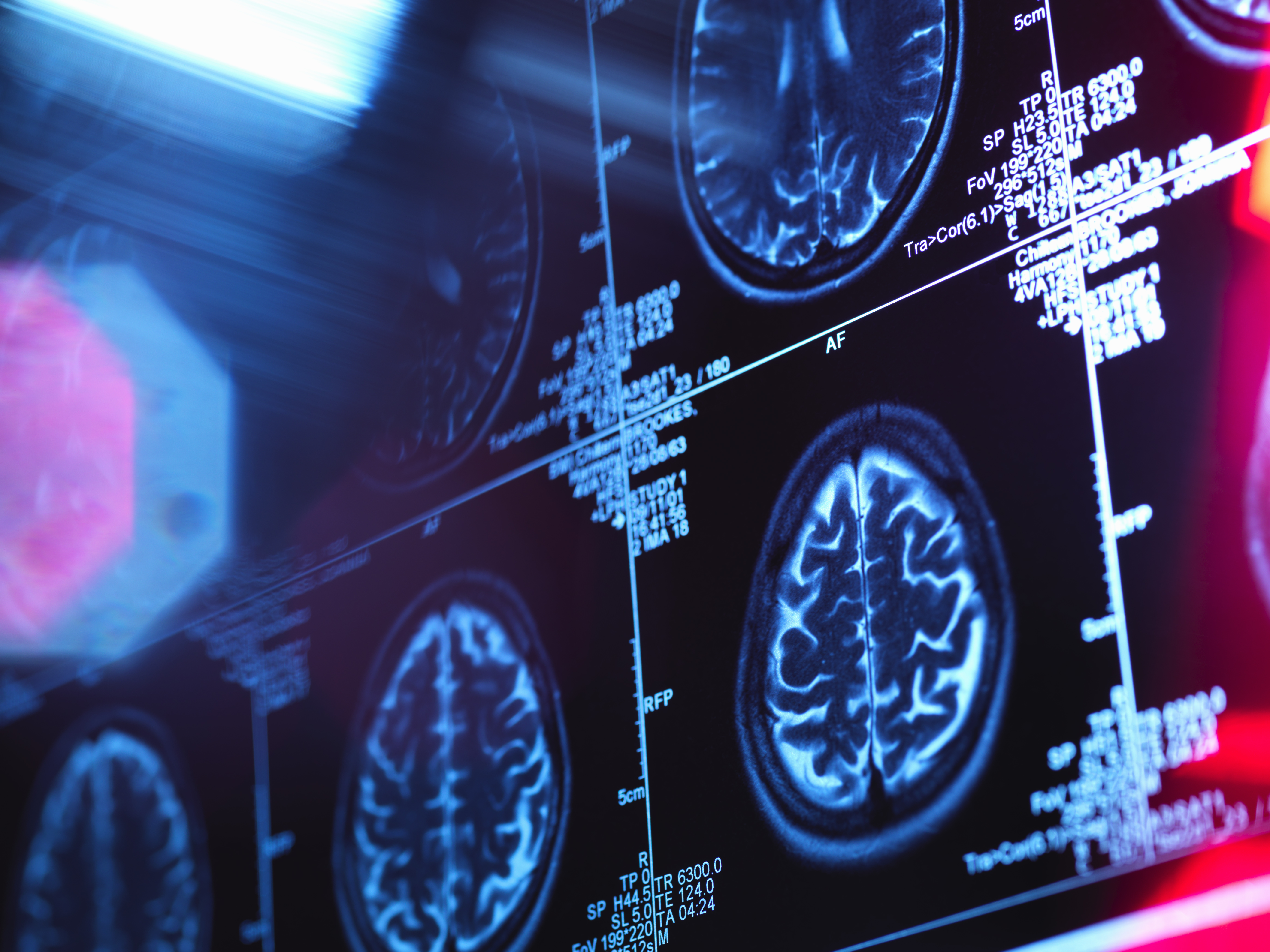 Rapid response in stroke patients is the picture of patient safety