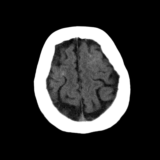 qer algorithm with ICH